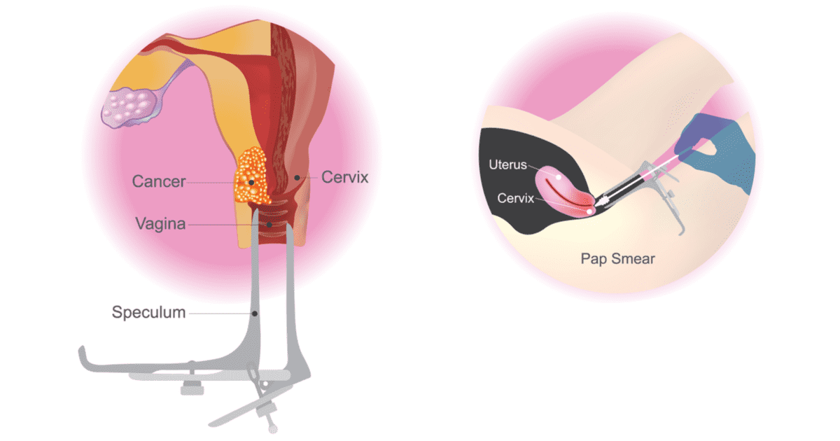 pap-smear-cervical-cancer