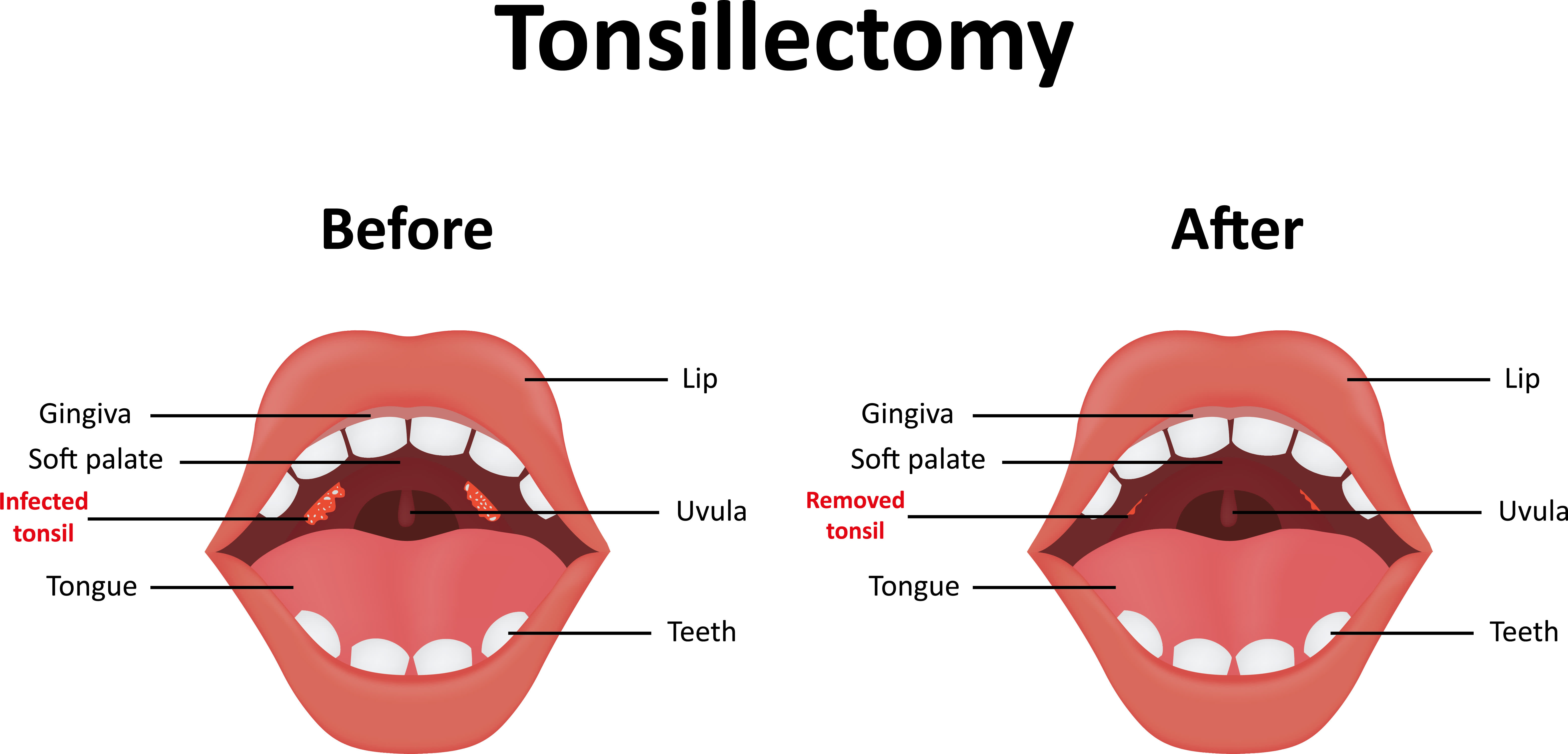 worst-tonsil-stones-tonsillolith-questions-and-answers-youtube