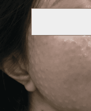 Example of post-treatment bumps on the face