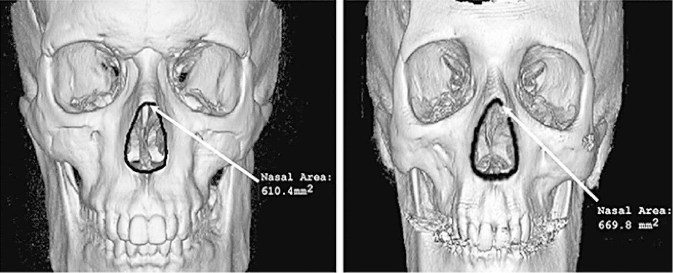 3D tomographic image of skull