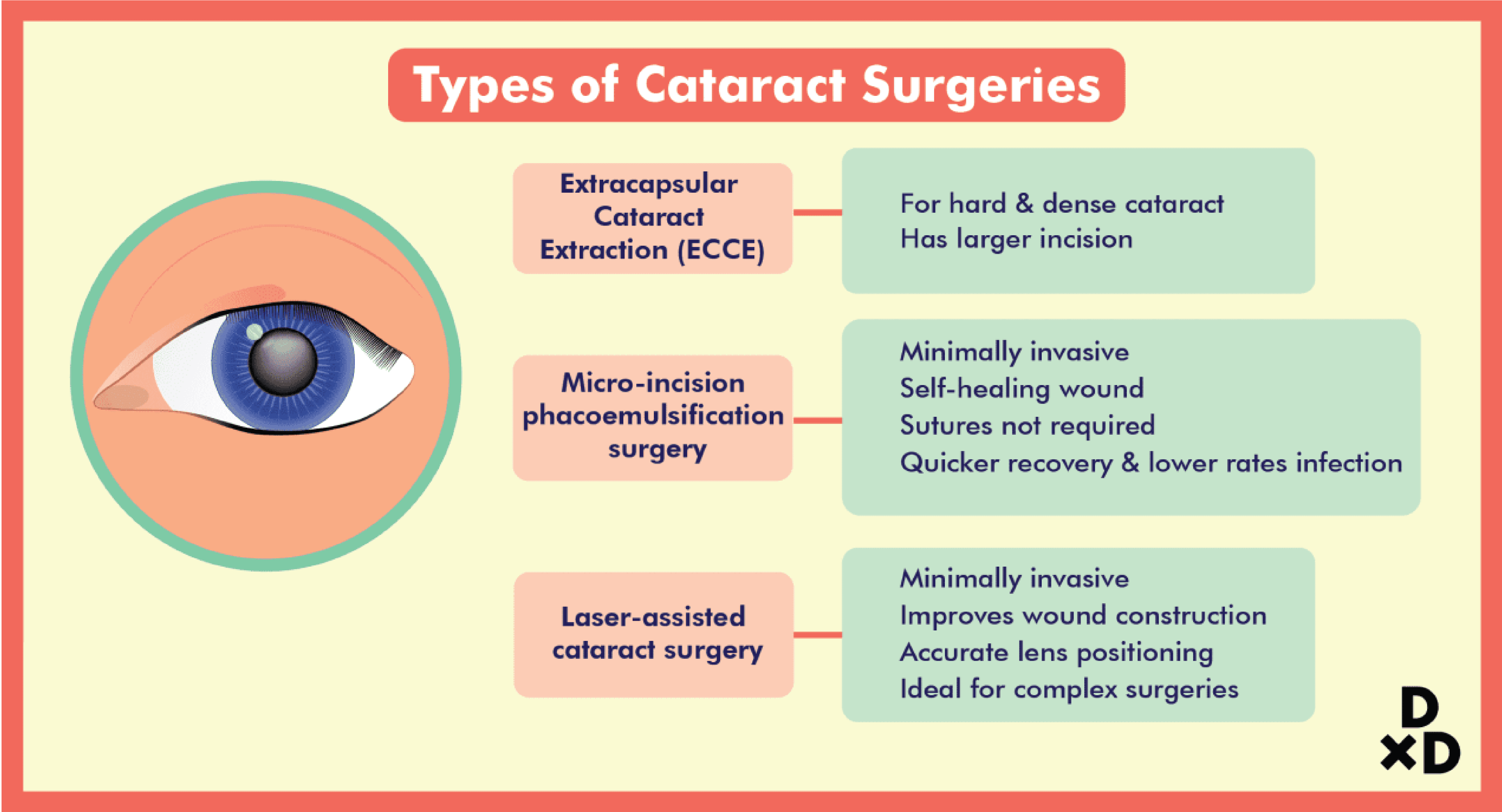 A Comprehensive Guide to Cataract Surgery in Singapore by