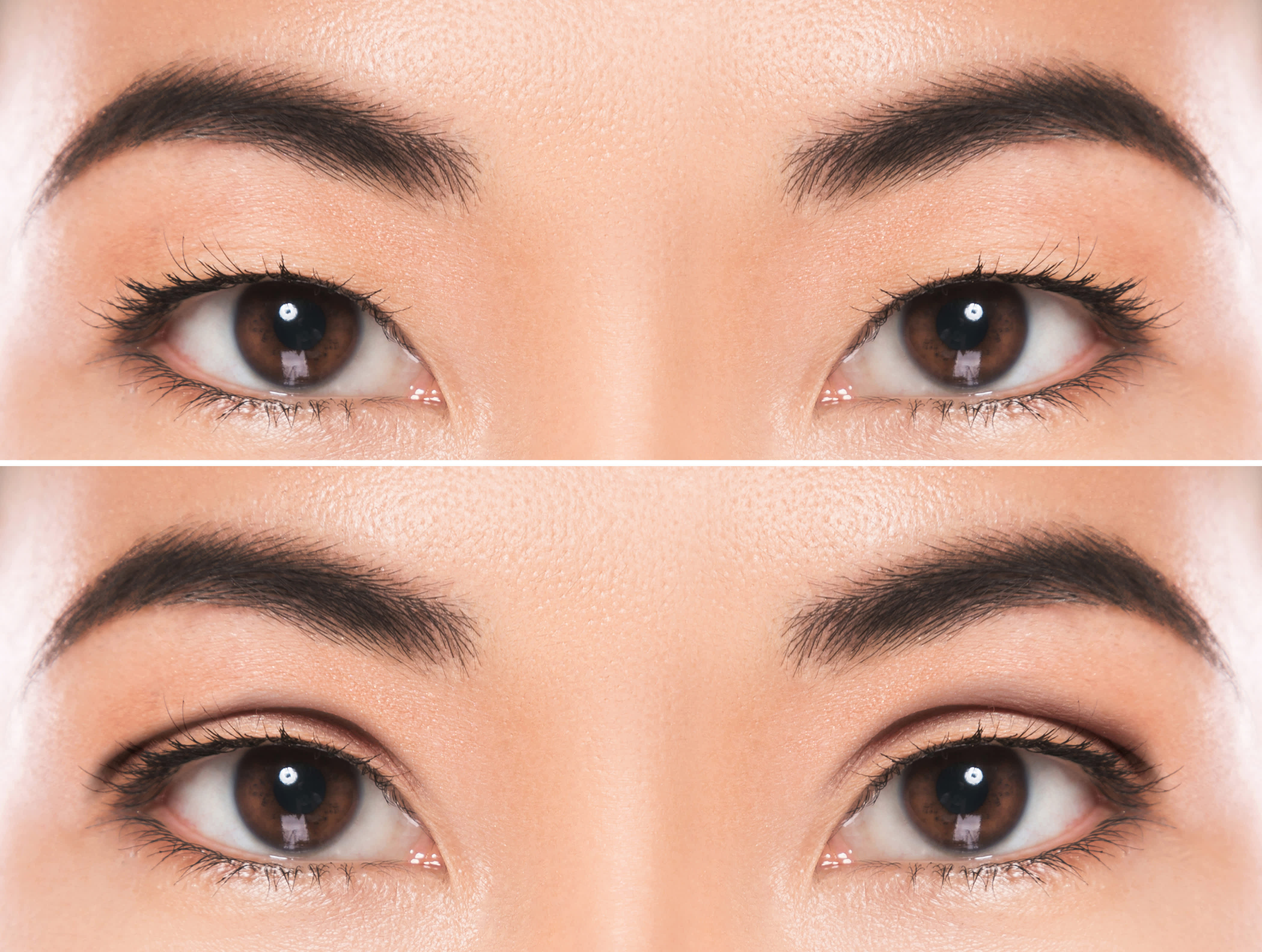 non invasive double eyelid surgery