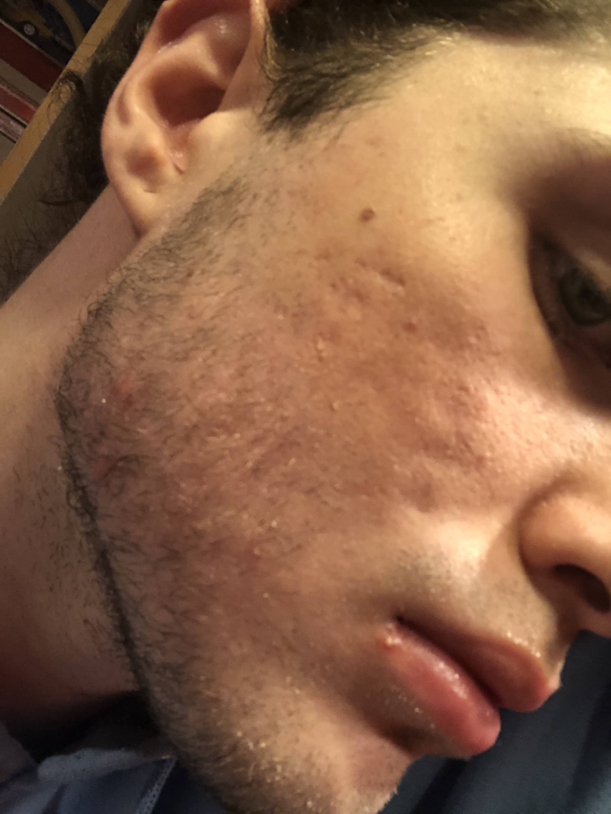 acne scars before and after accutane