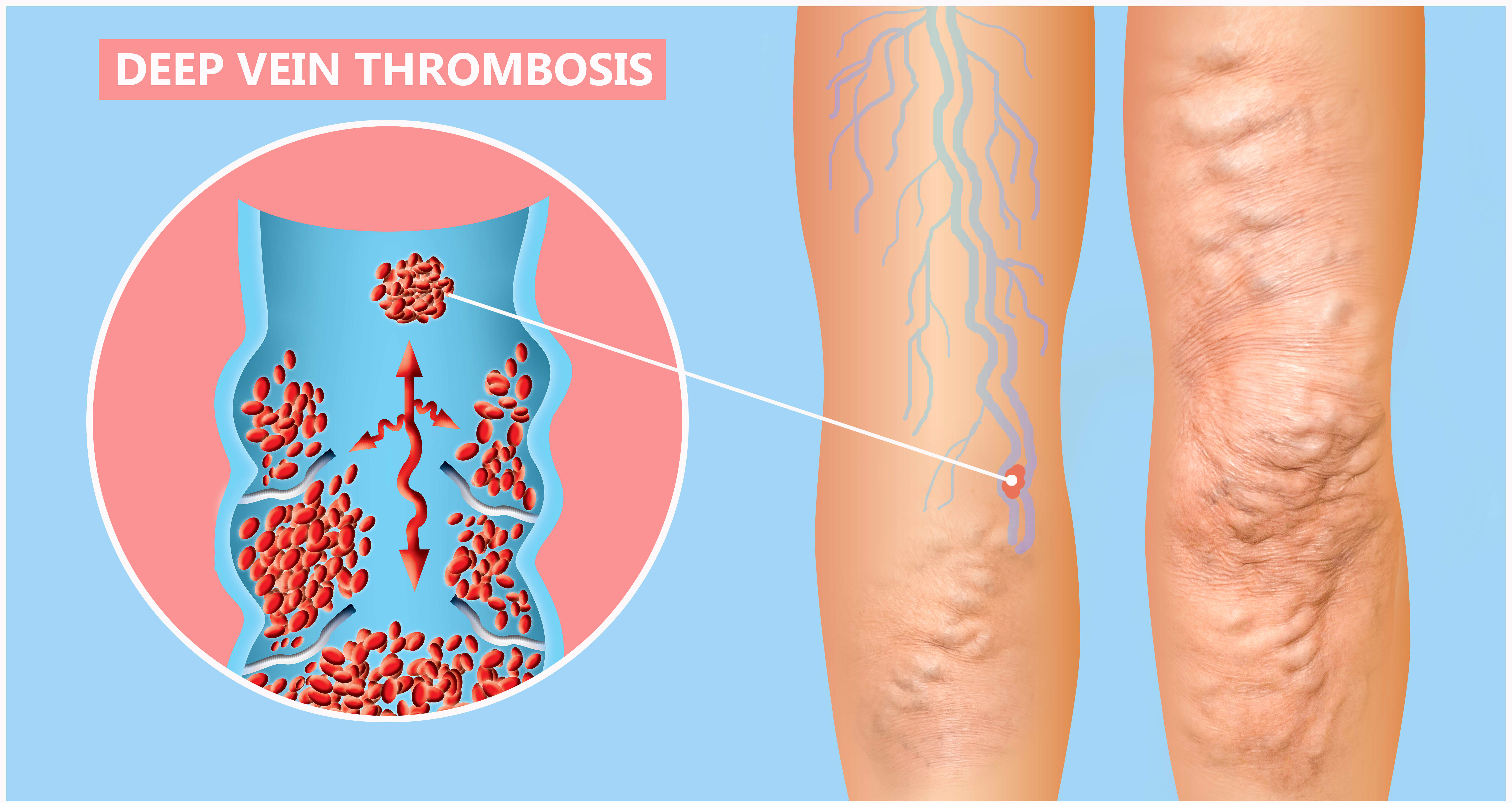 Symptoms of Deep Vein Thrombosis DVT