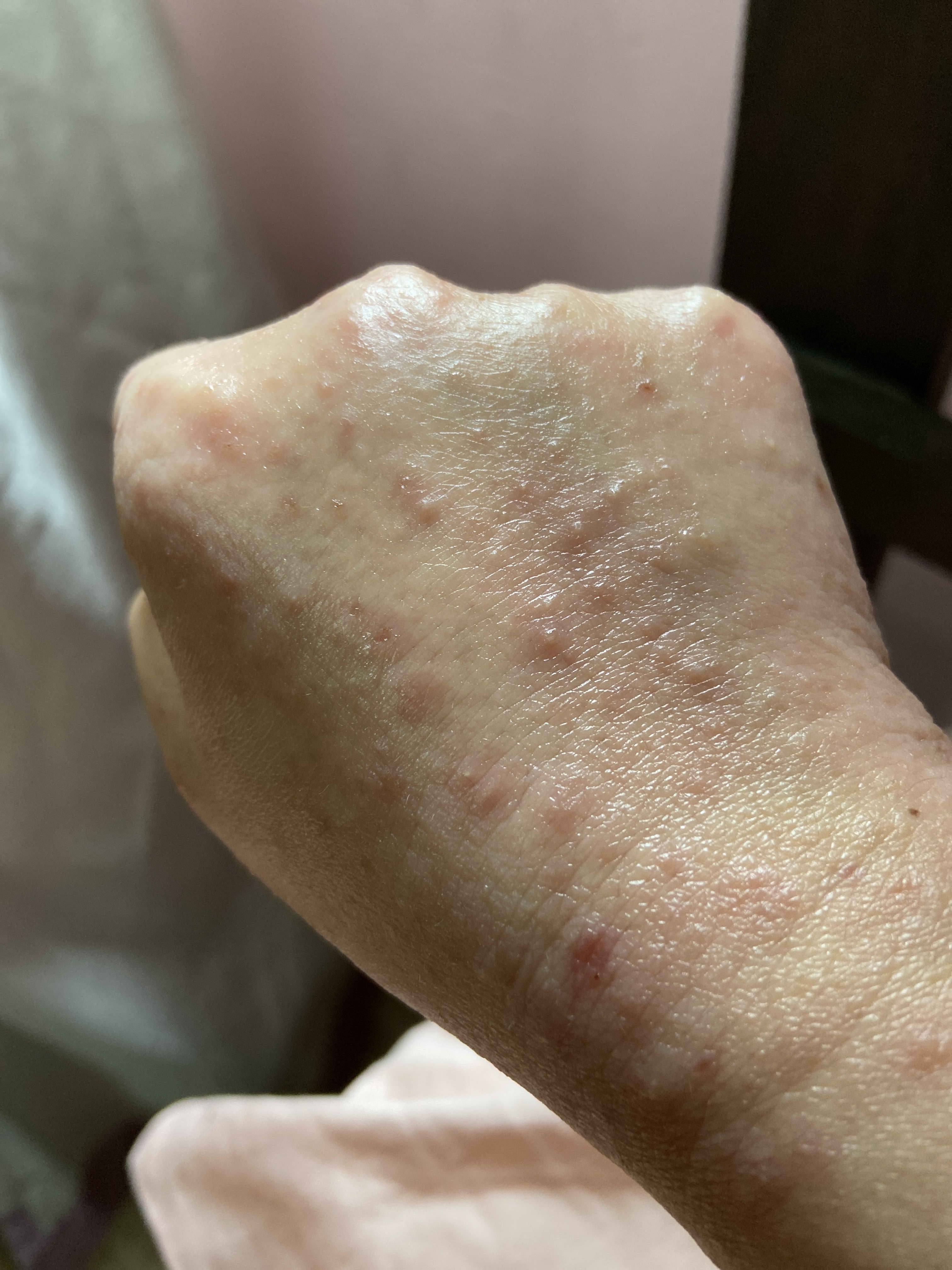 What Do I Do If I Suffer From Eczema And My Hand And Arm Suddenly Develop A Lot Of Rashes 4088