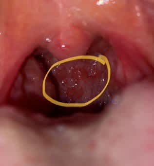 bumps on back of throat