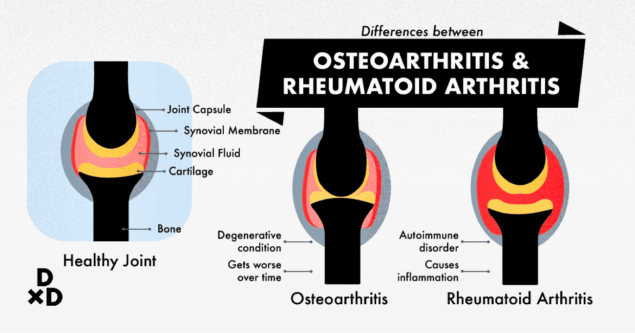 Differences between osteoarthritis & rheumatoid arthritis