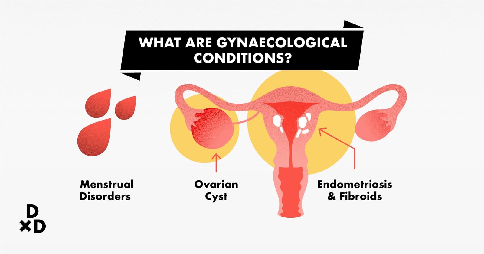 What are gynaecological conditions, infographic