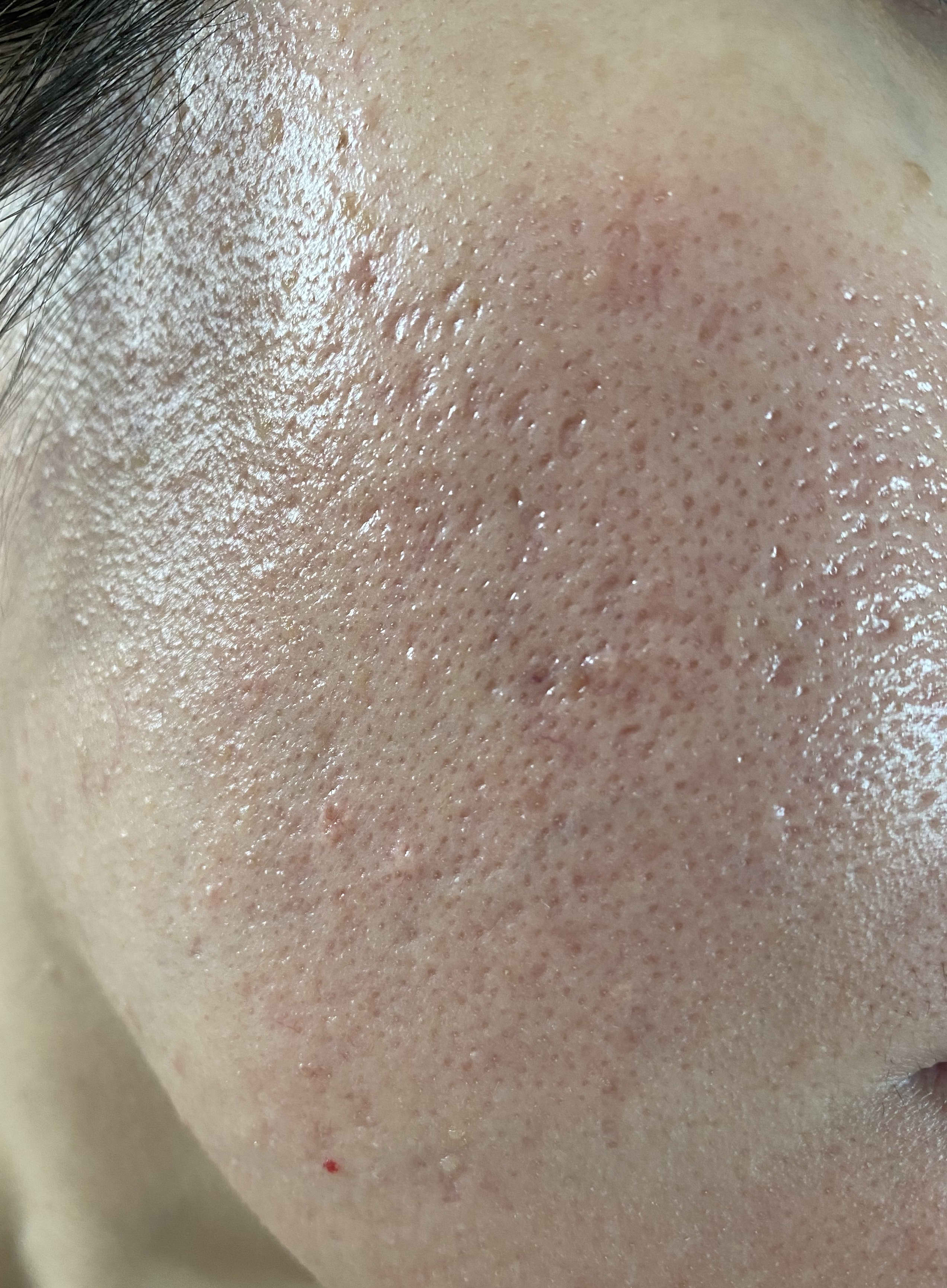 small pores on face