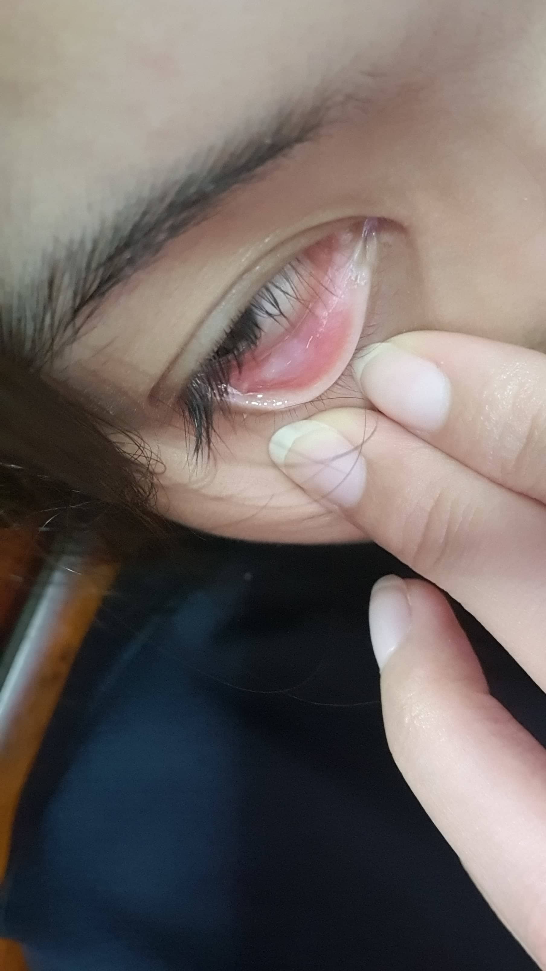 eyelids crusted shut in morning