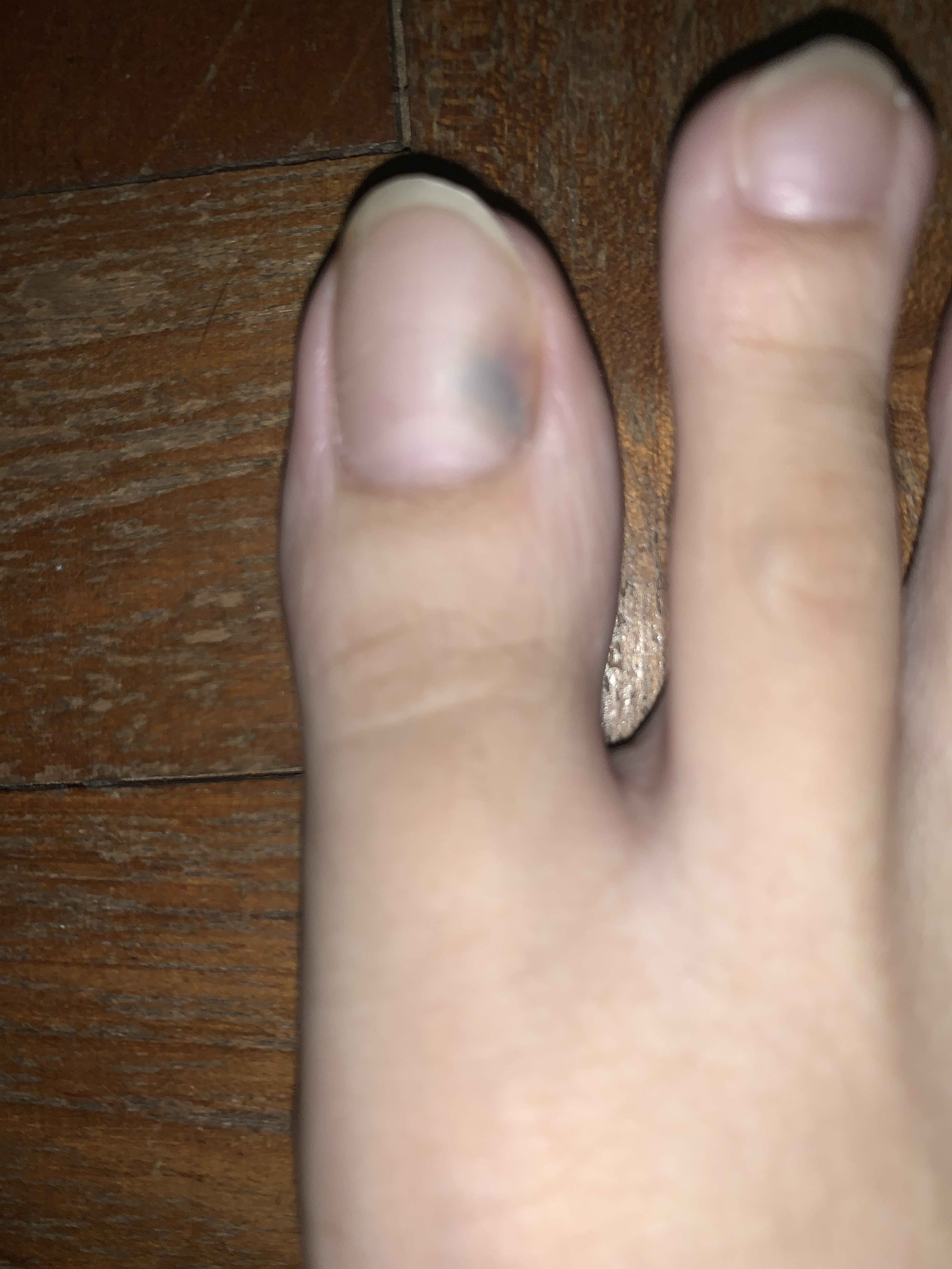 How can I tell if my toenail has a blood clot from injury or fungal  infection? (Photo) - human