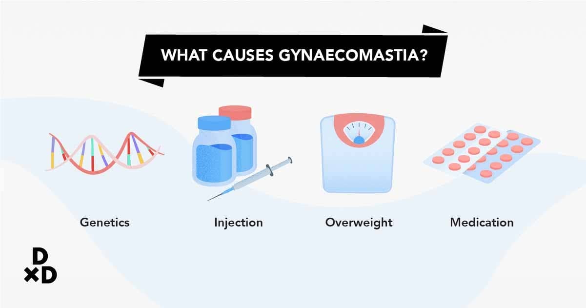 Causes of gynaecomastia, 4 causes