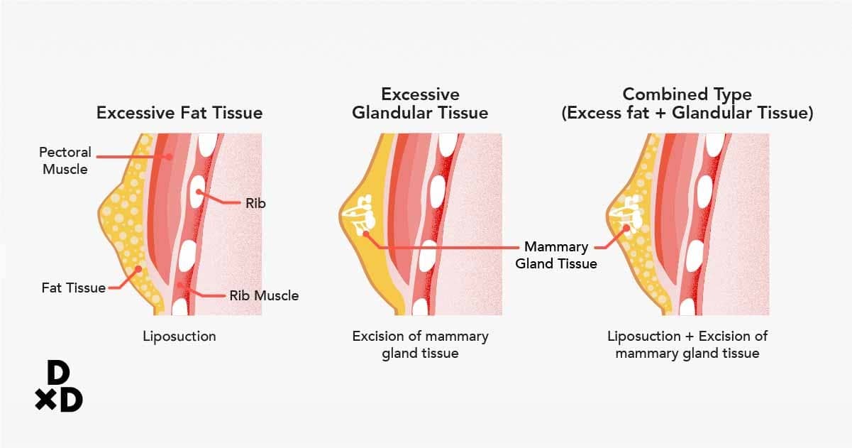 types of gynaecomastia