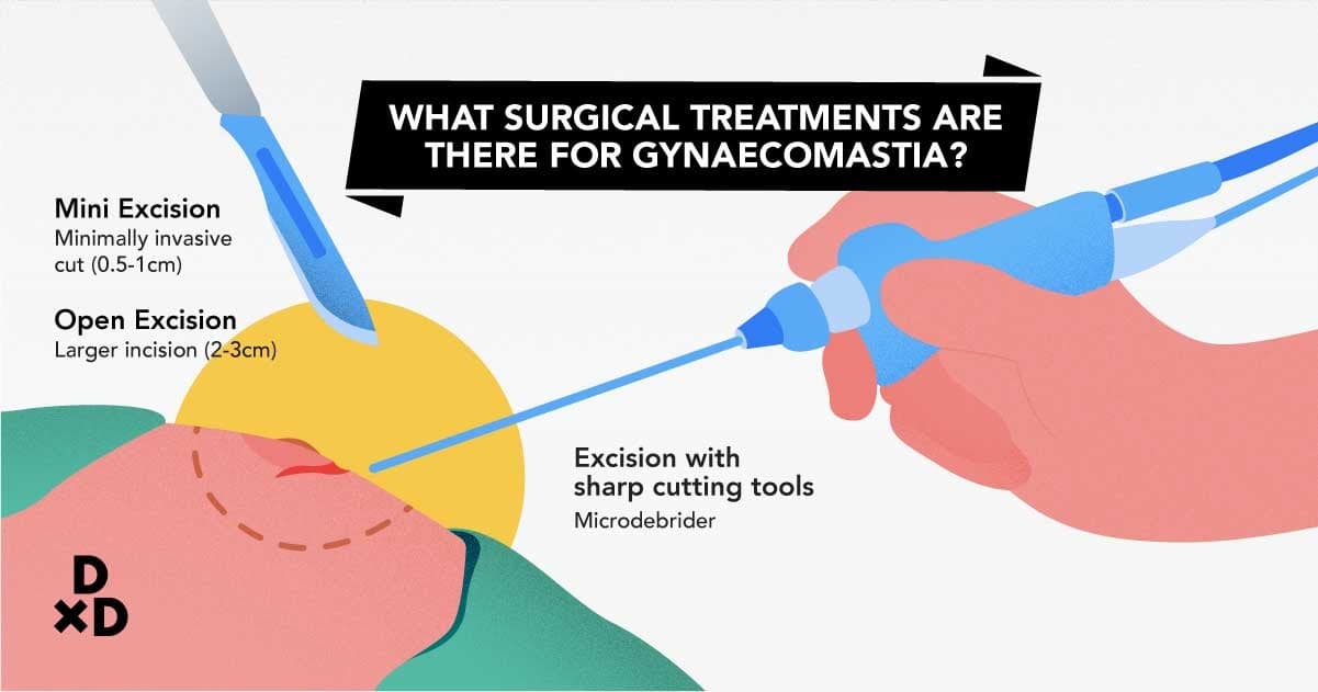 what surgical treatments are there for gynaecomastia?