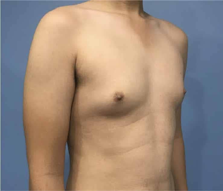 Example of grade 2 gynaecomastia