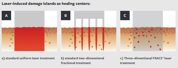 Laser-induced damage islands as healing centers