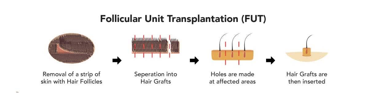 Follicular Unit Transplantation (FUT)