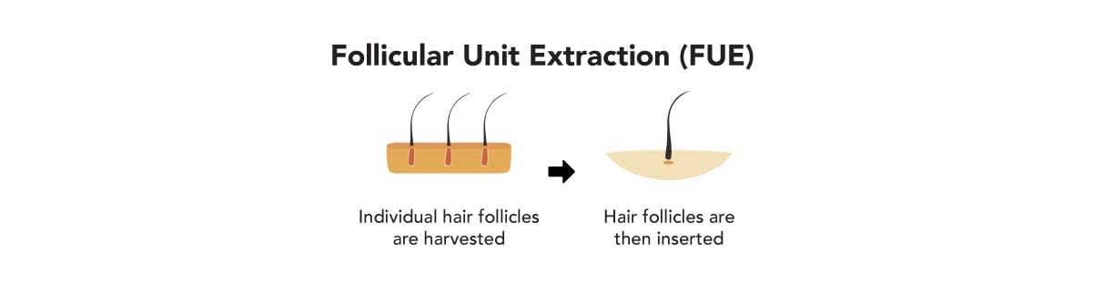 Follicular Unit Extraction (FUE)