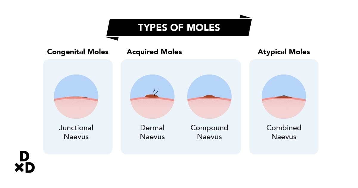 Types of moles