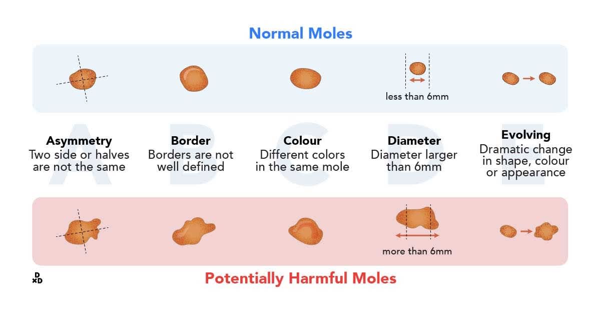 Normal moles vs Potentially harmful moles