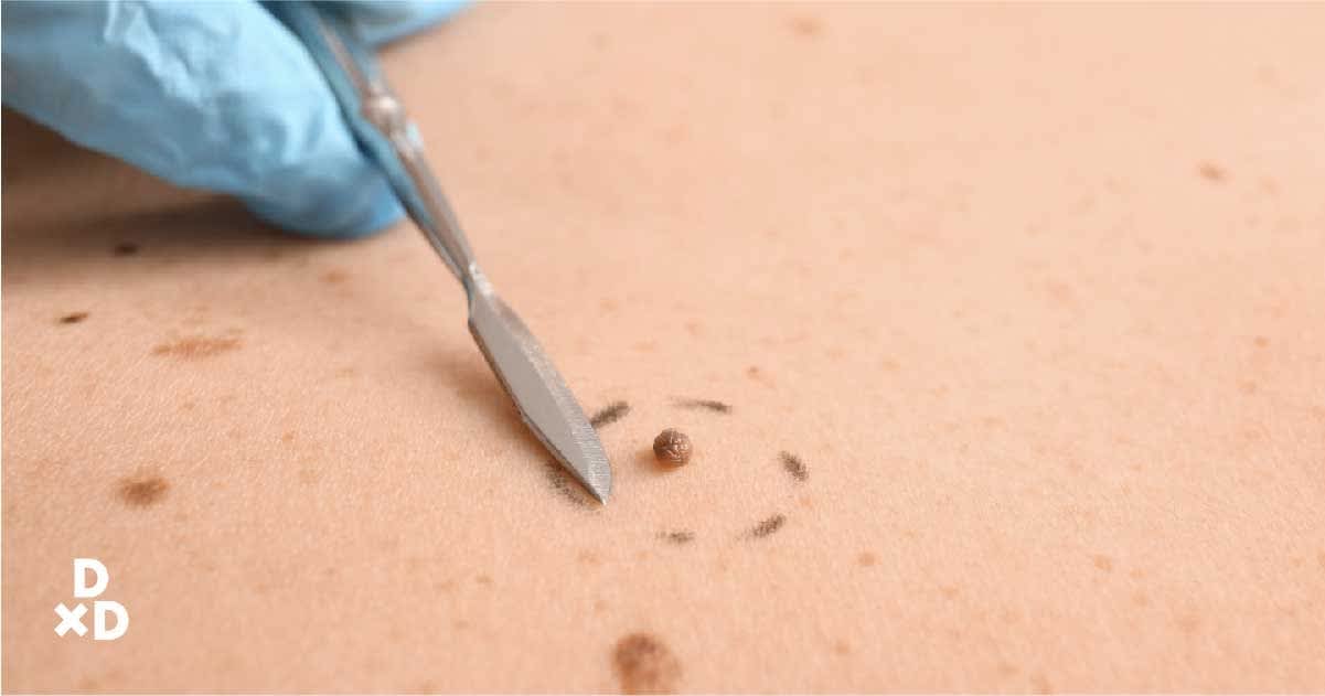 Mole removal with scalpel