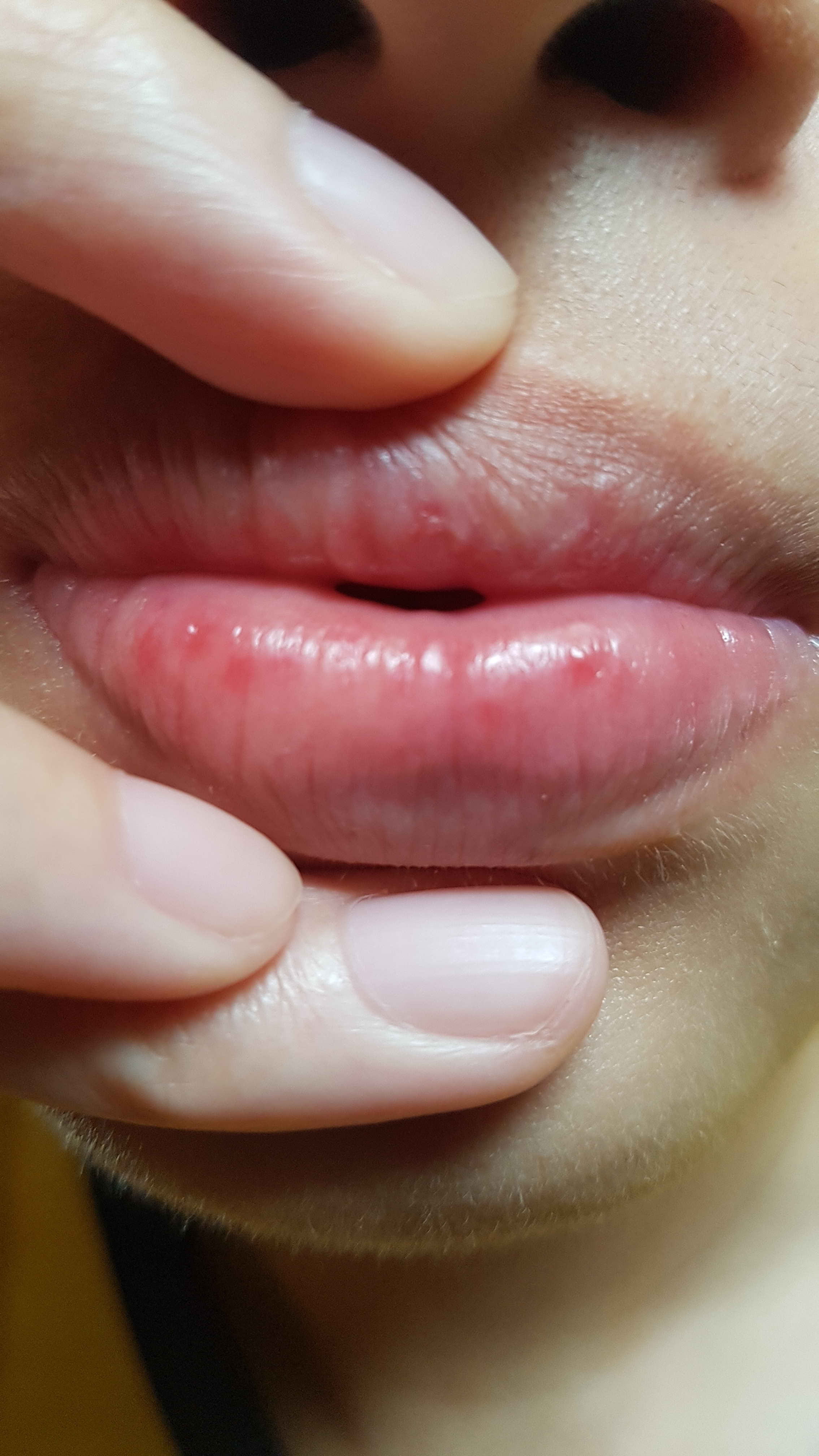 how-can-i-tell-that-the-bumps-on-my-lips-are-a-rash-or-hsv-or-something