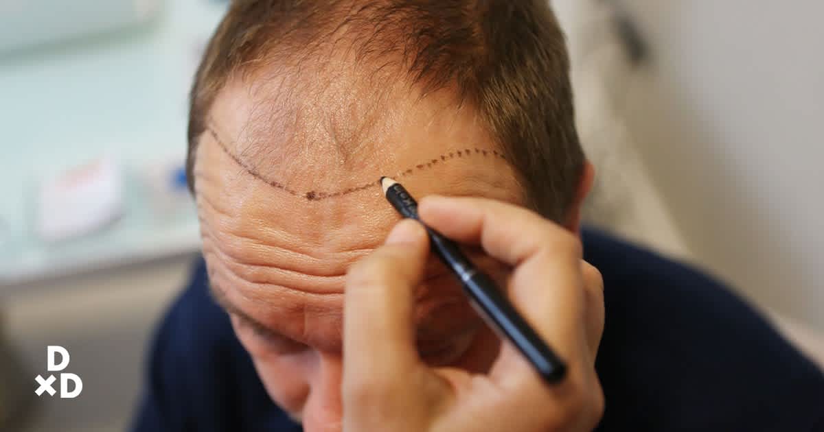 Man having his head marked for hair transplant