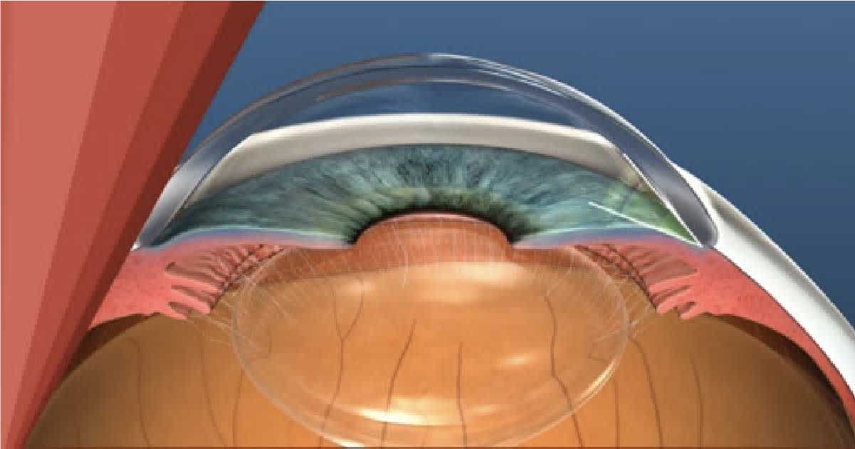 Common Types of Glaucoma, close up of cornea and iris, trabecular meshwork