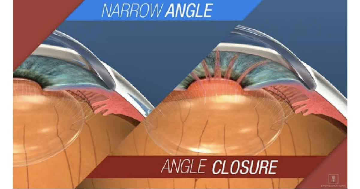 Angle-closure/Narrow-angle Glaucoma type