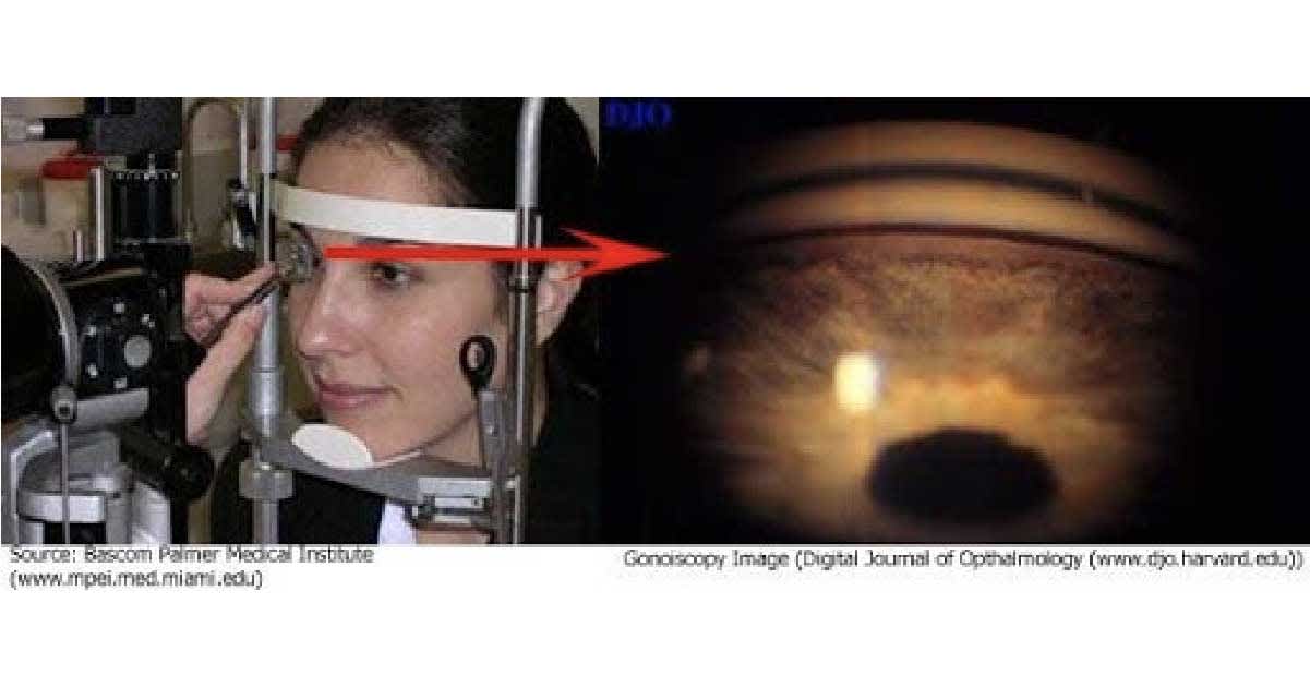 Gonioscopy, checking drainage angle, screening for glaucoma