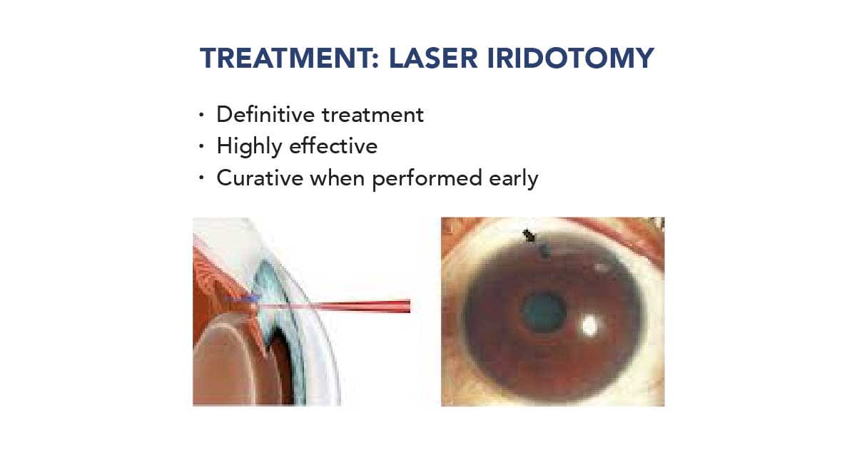 laser iridotomy treatment for angle-closure glaucoma