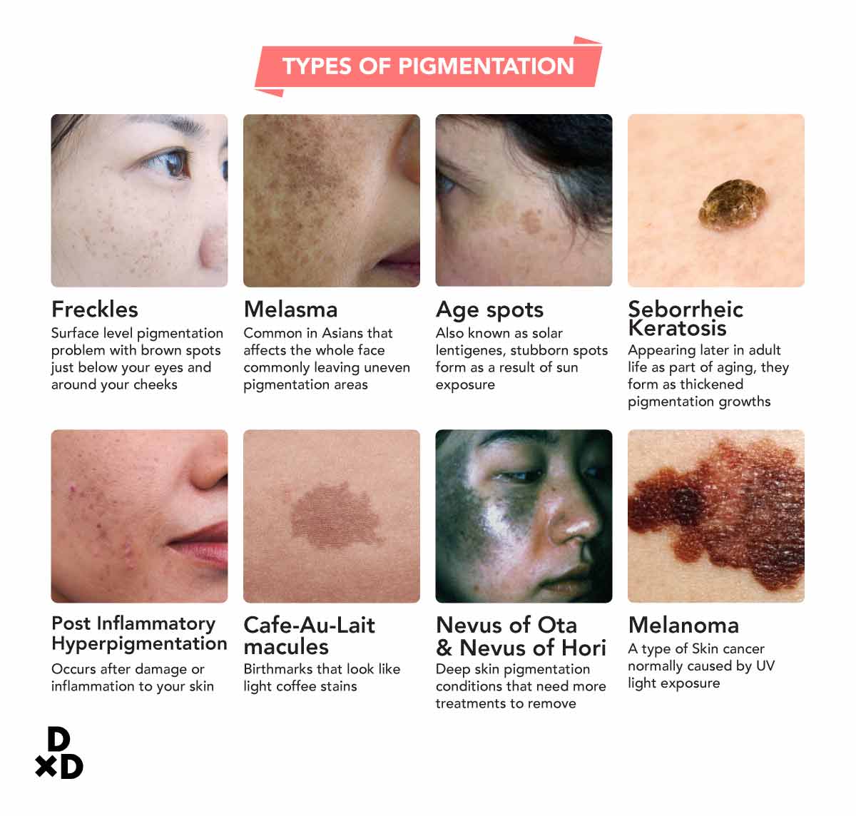 different types of pigmentation