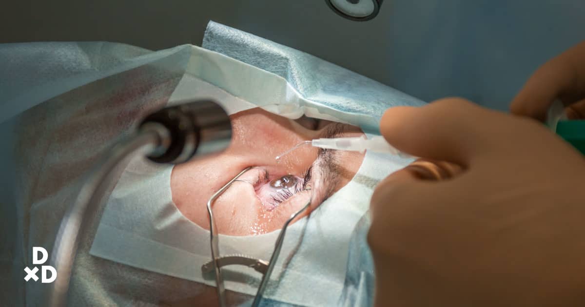 LASIK surgery