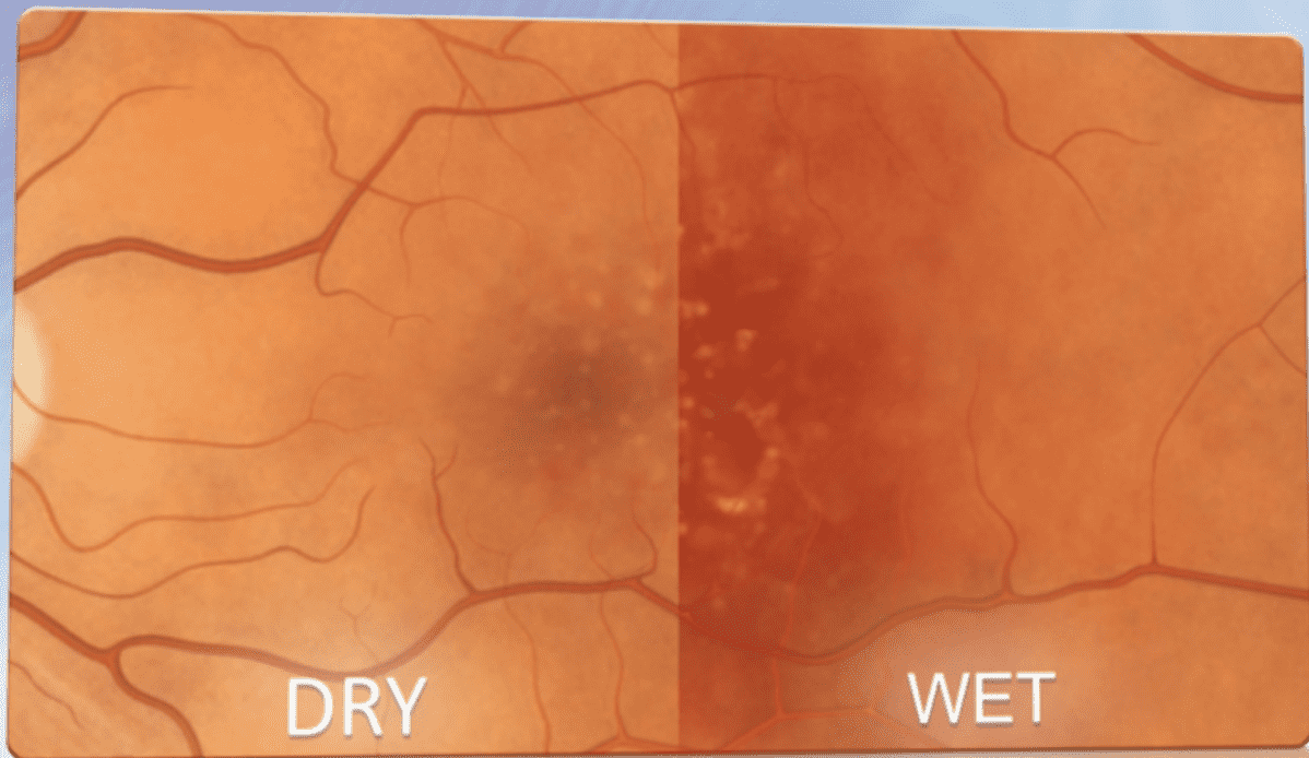 Dry and wet AMD