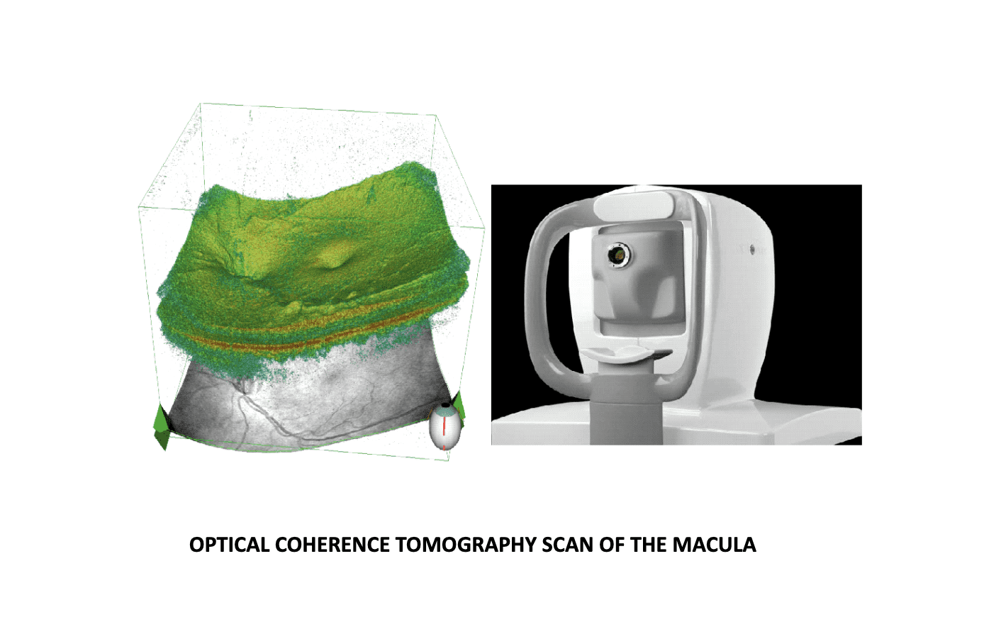 Optical Coherence Tomography Scan of The Macula