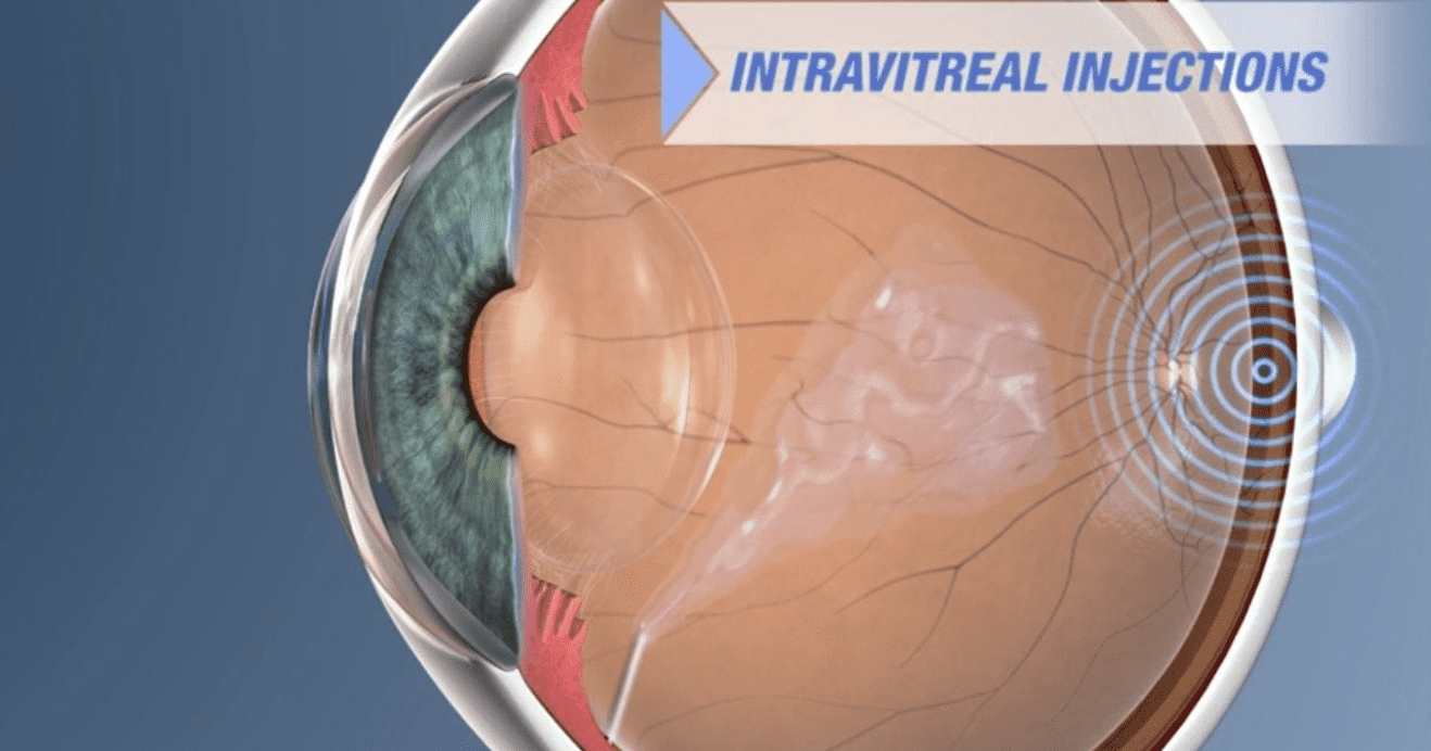 Intravitreal injections