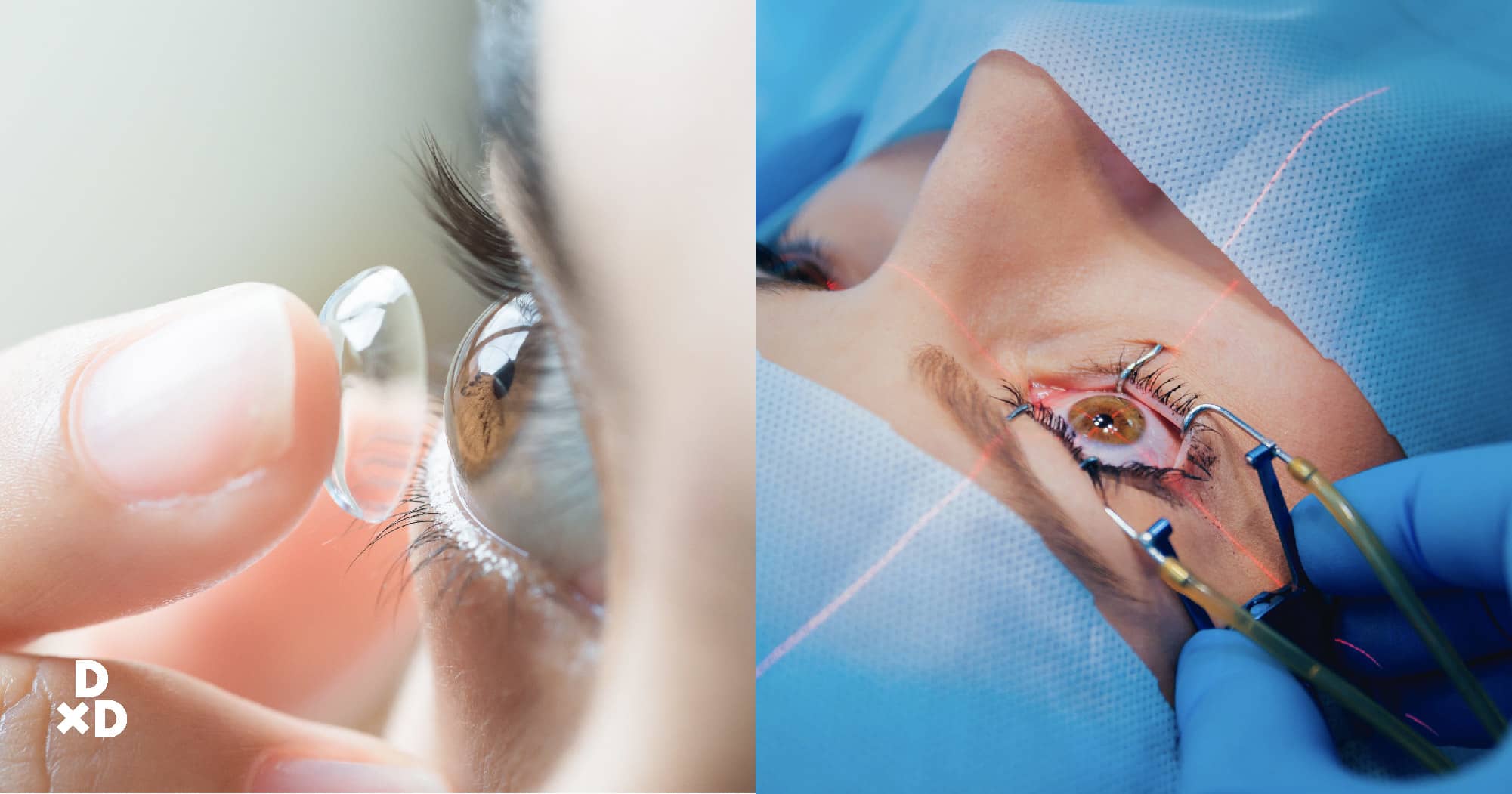 LASIK surgery