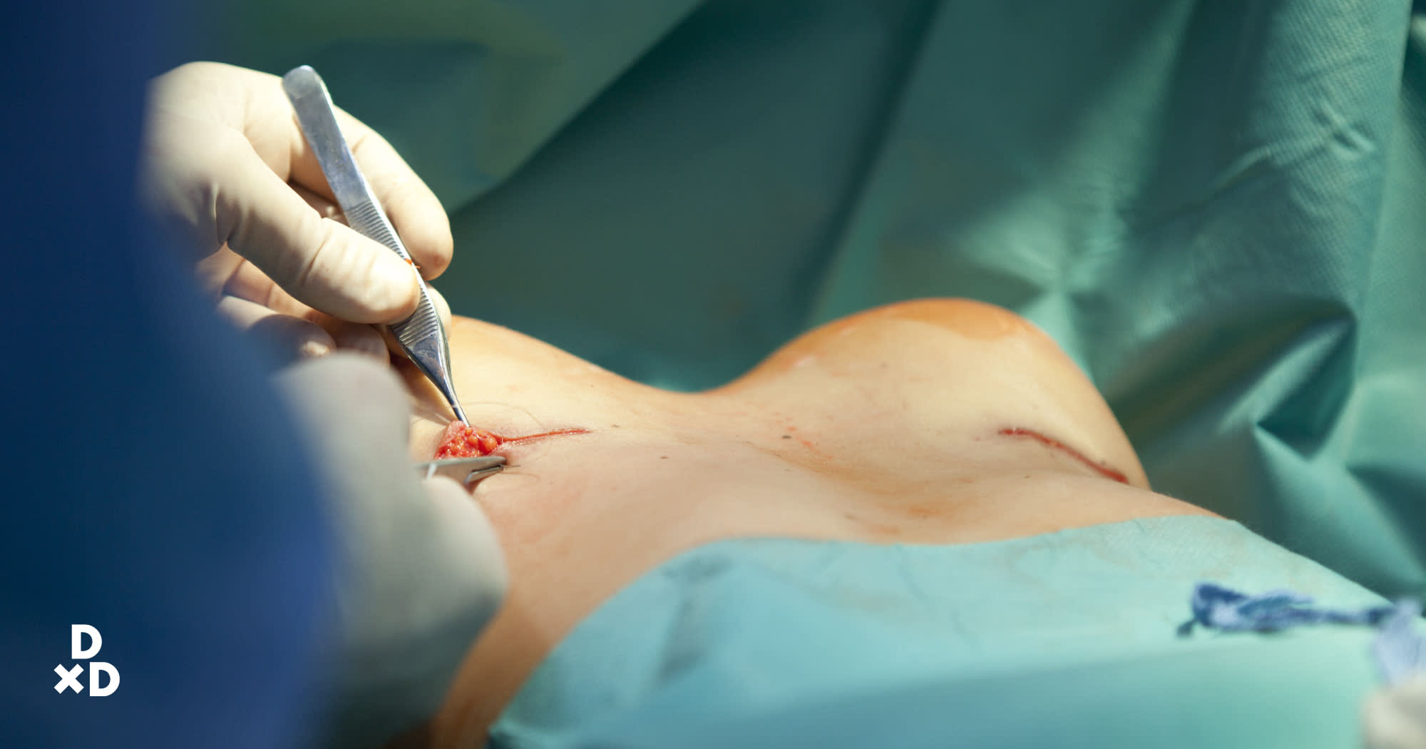 Breast Implant Incision