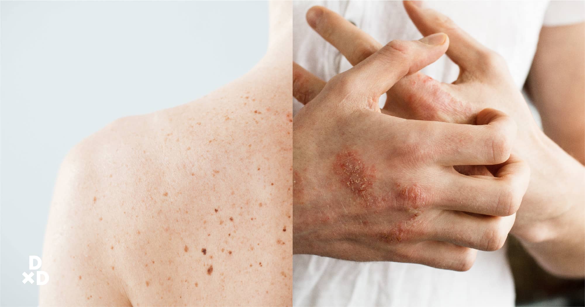 symptoms skin cancer singapore