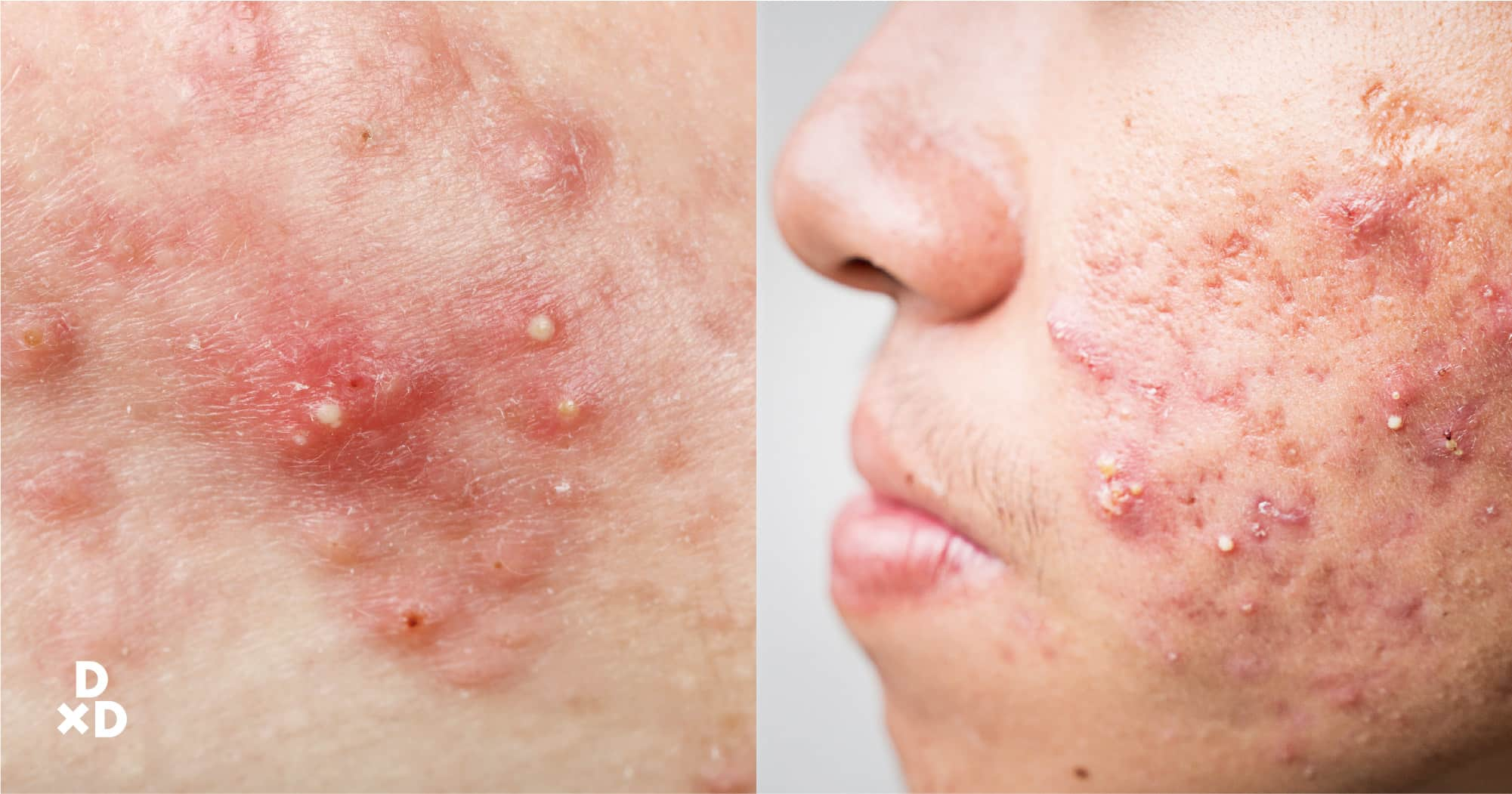 Severe Acne