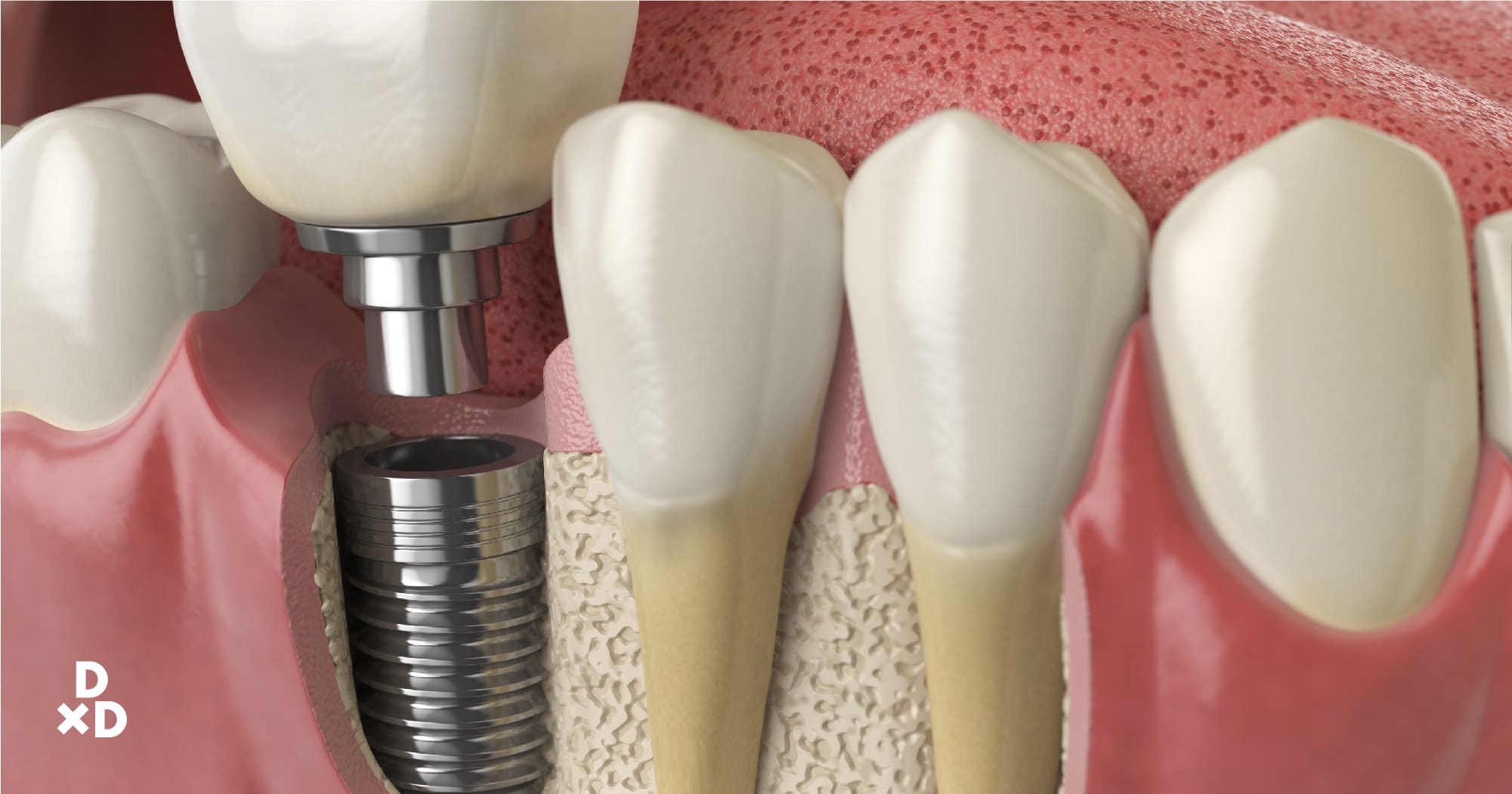 types of dental implants