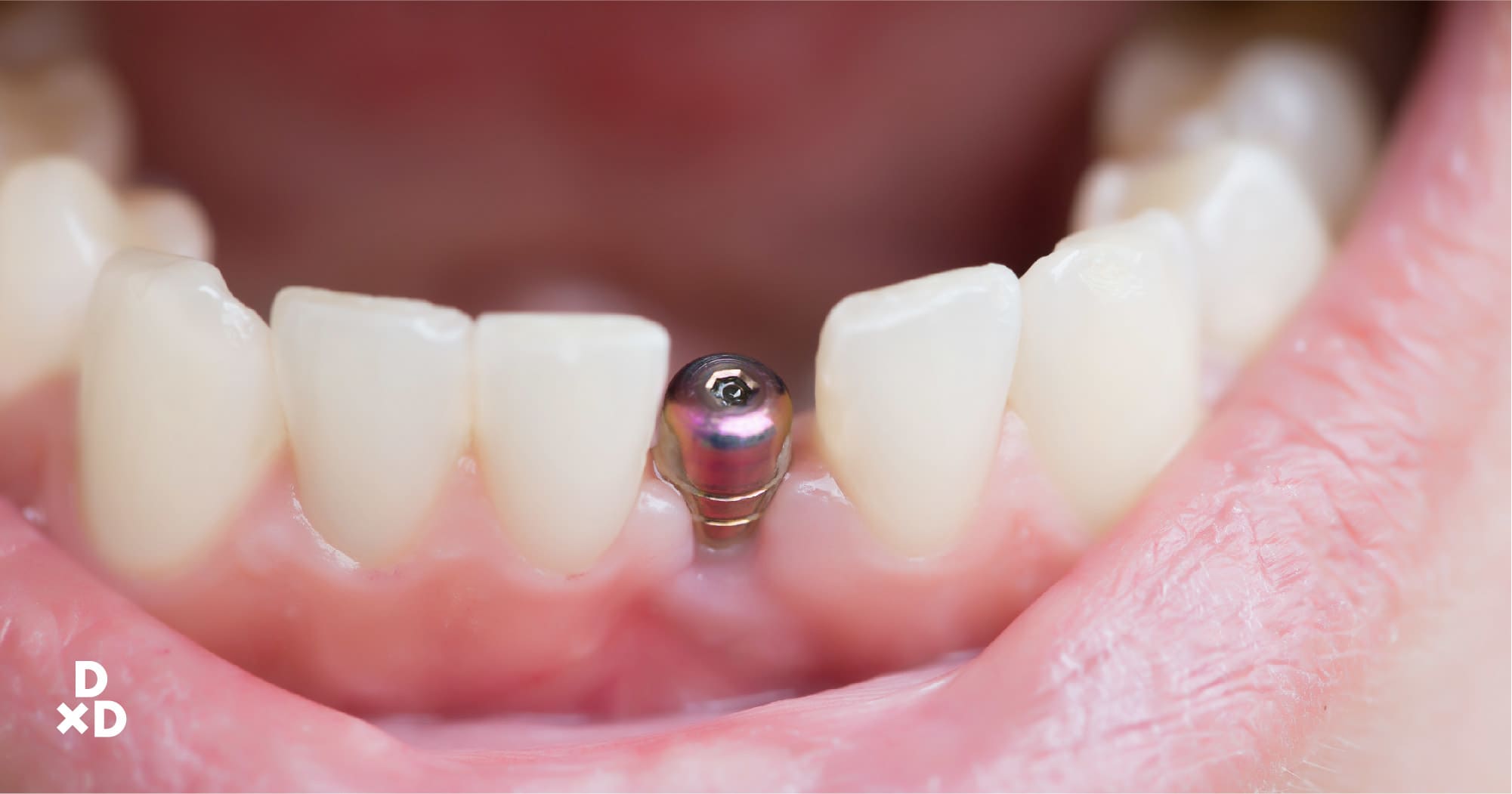 do dental implants need to be replaced