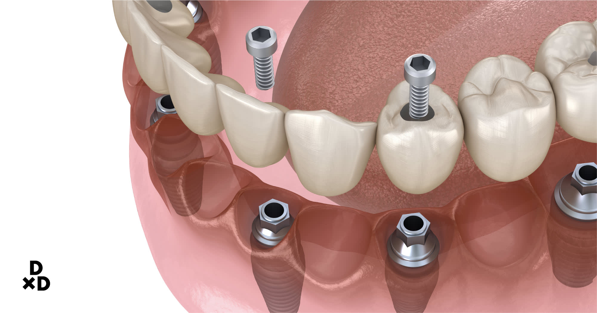 dental implant illustration