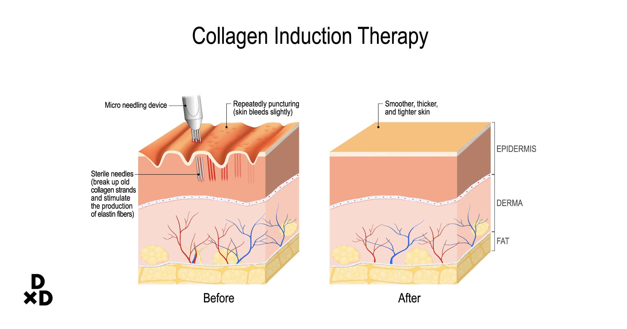 collagen induction therapy