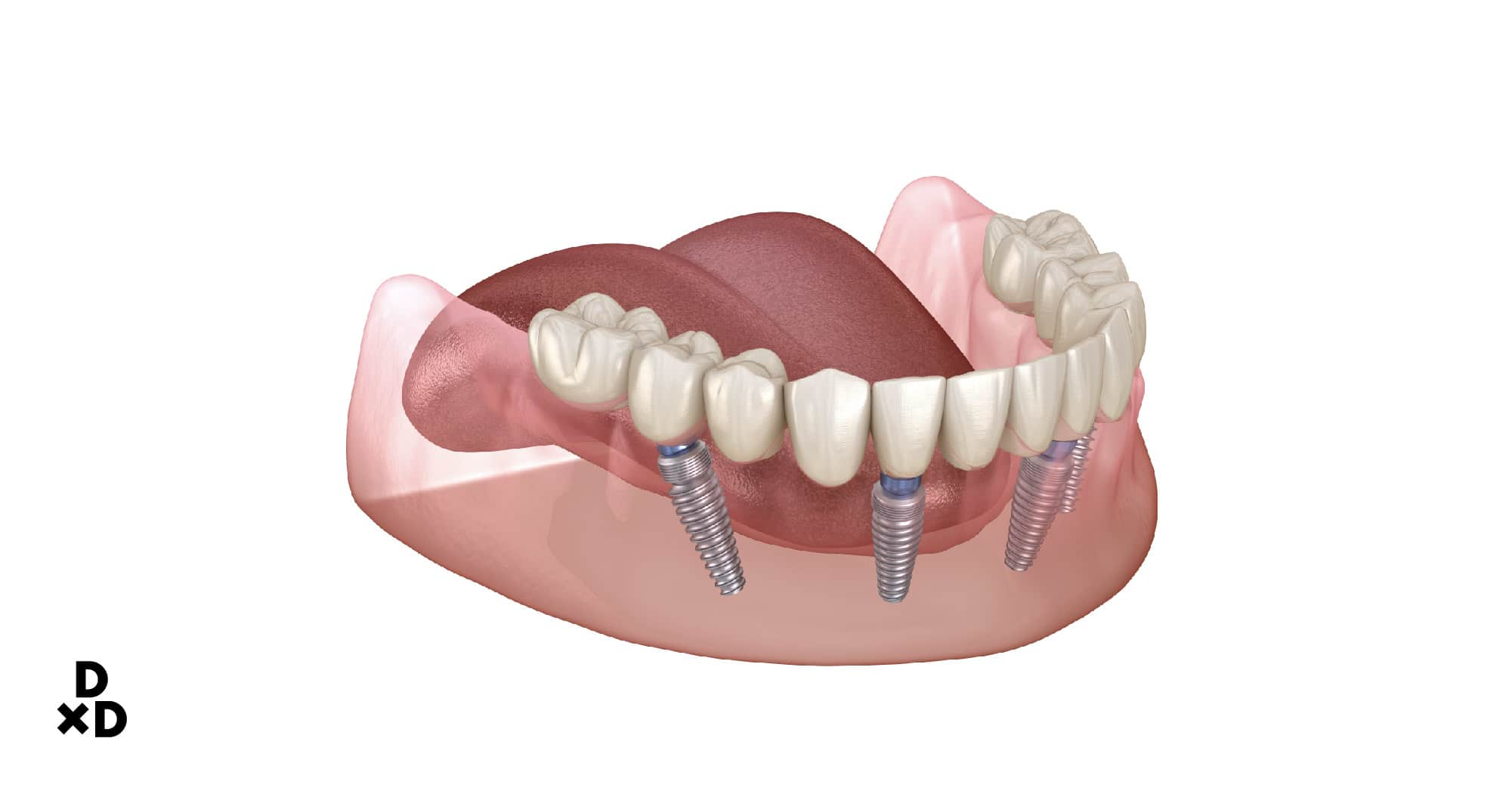 How do All-On-4 dental implants work