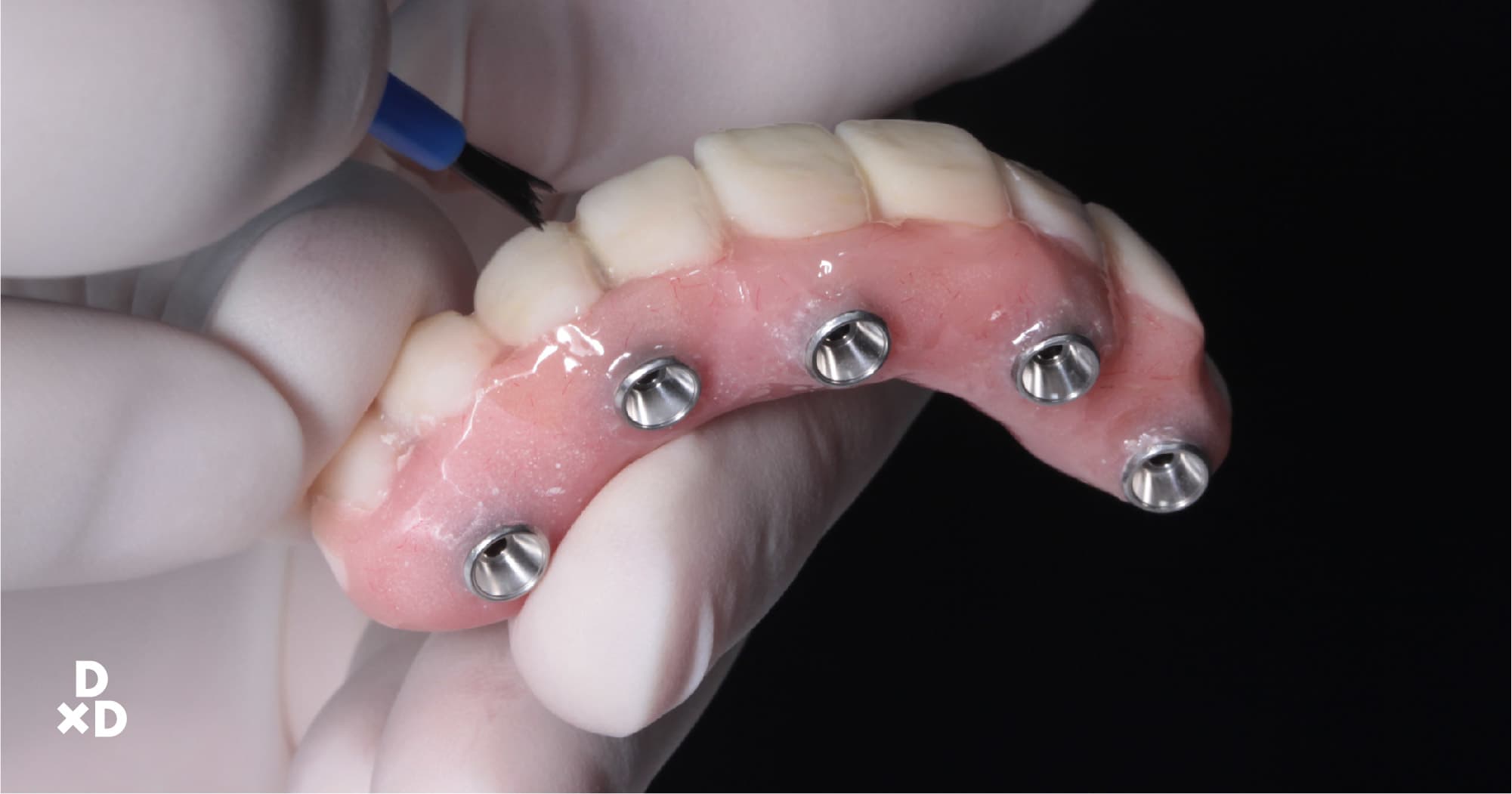 Who needs All-On-4 Dental Implants