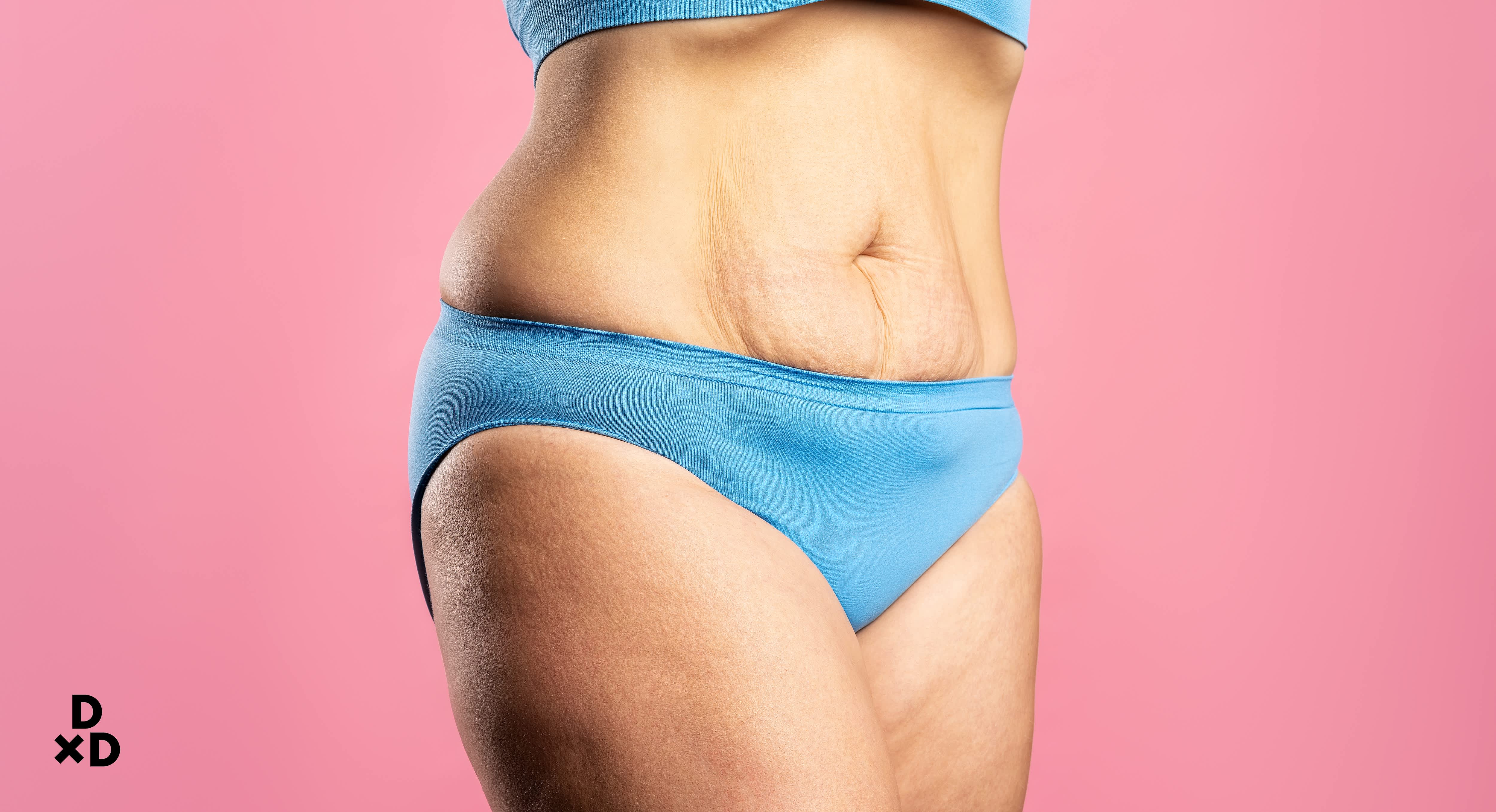 truSculpt can help with loose, saggy skin