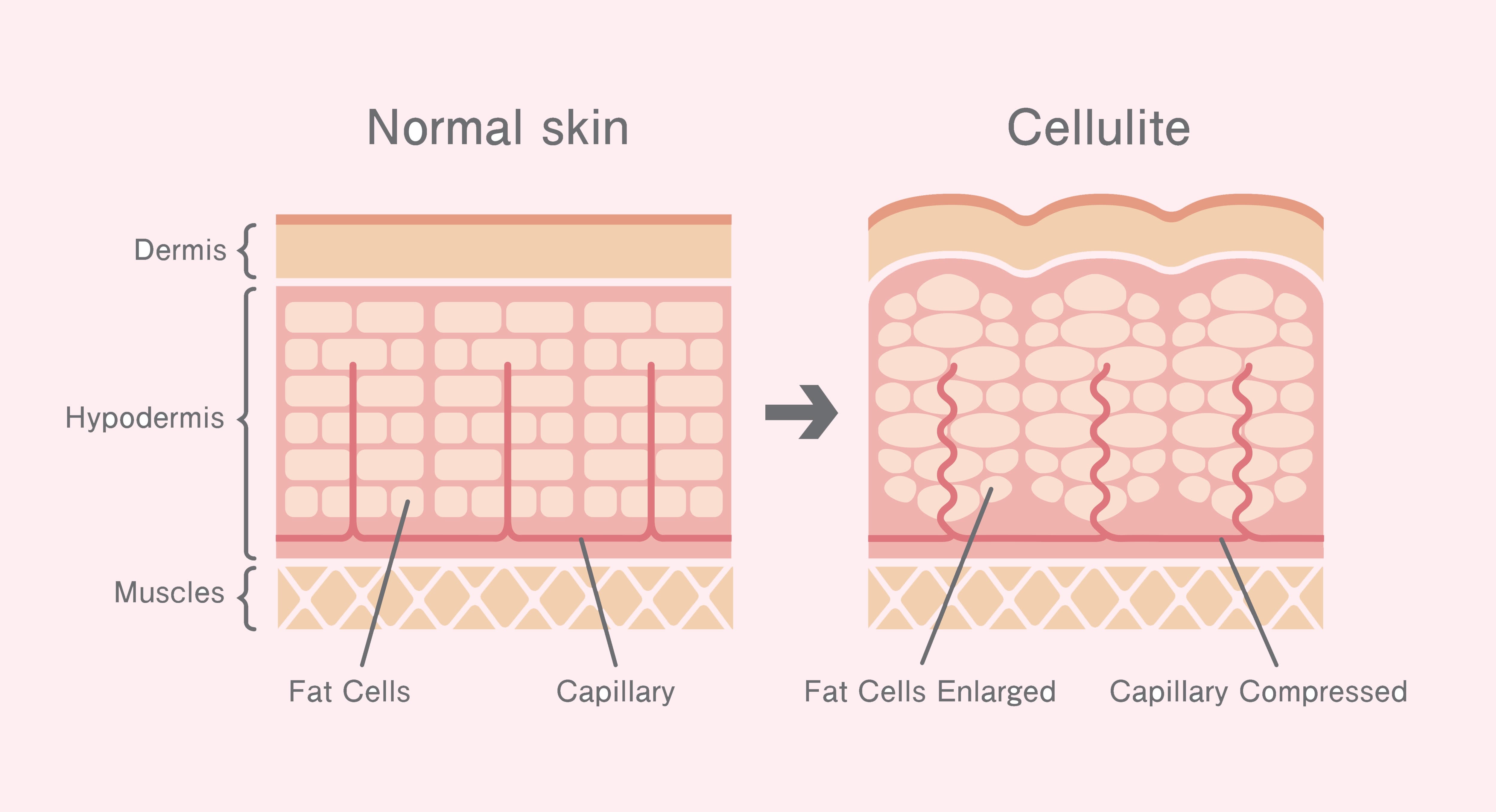 Normal skin vs cellulite