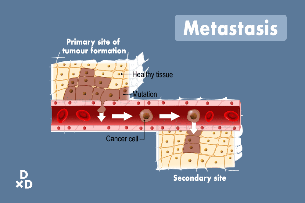 Metastasis