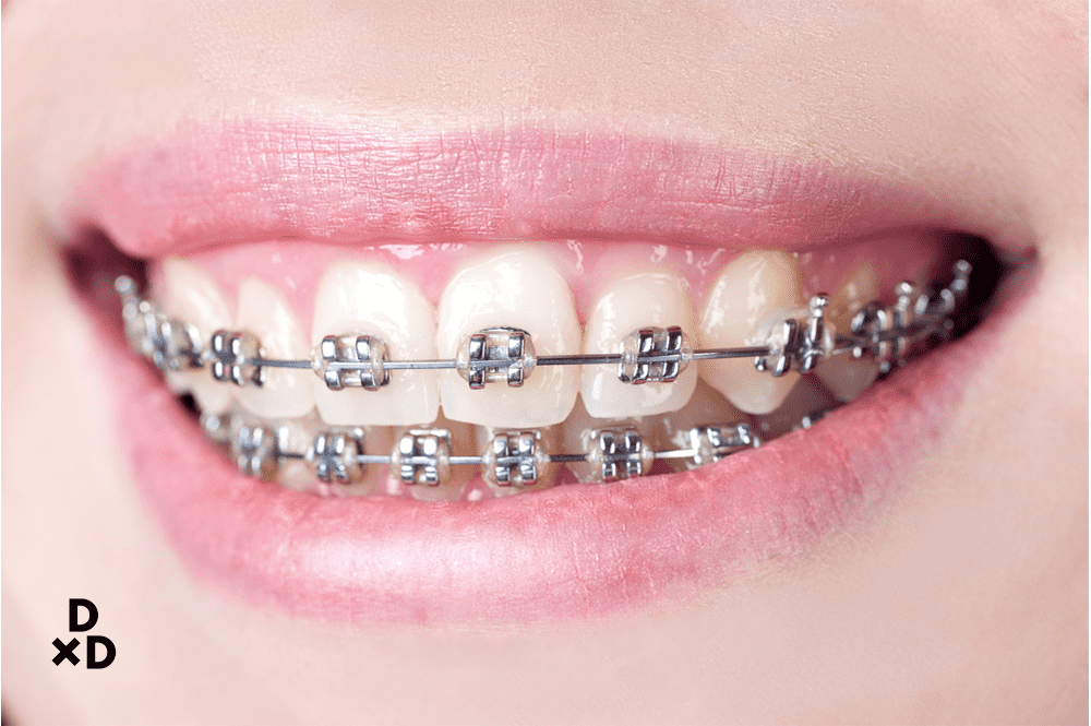 braces